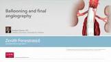 Zenith Fenestrated Graft, 1 Each