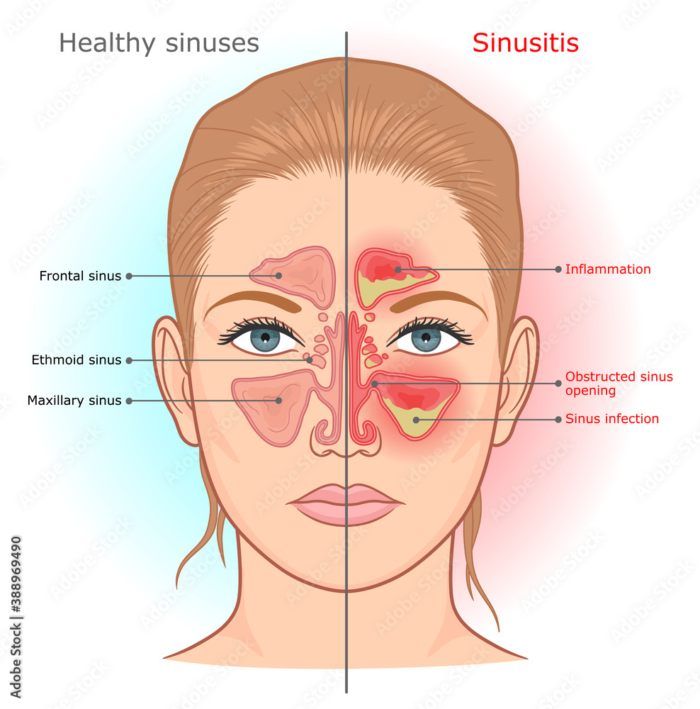 SINUS LIFT 22.9X10.1X5.0MM