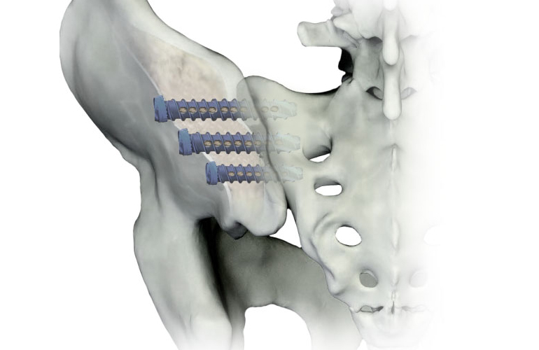 SCREW B02158080 SACROILIAC 8X80MM