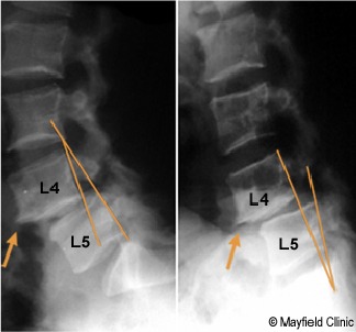 HOOK B02200010L PARS FRACTURE LEFT