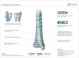 Tibial Sizing Plate