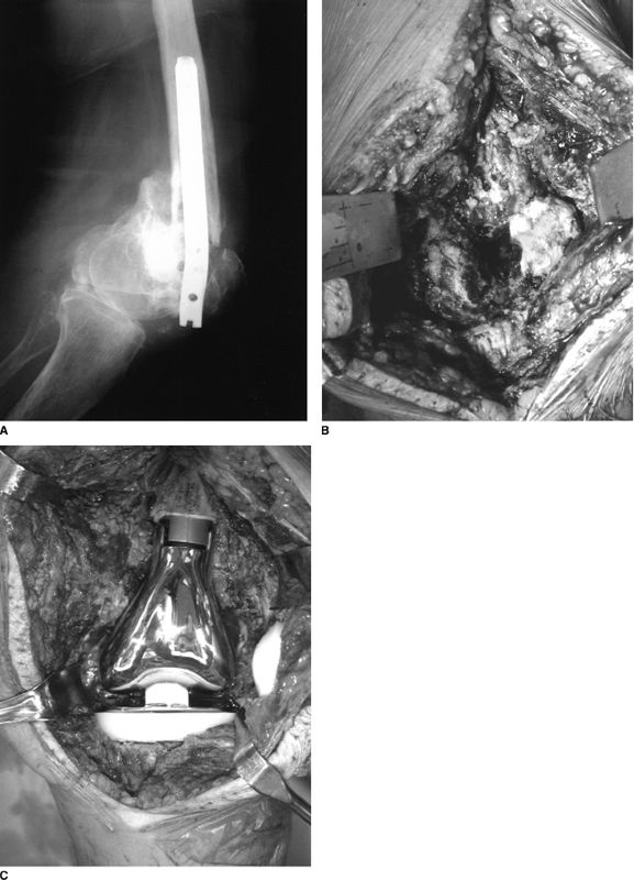 Trial Condylar Replacement