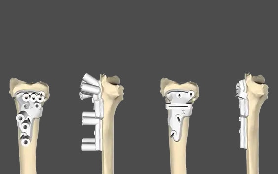 Osteotomy Guide
