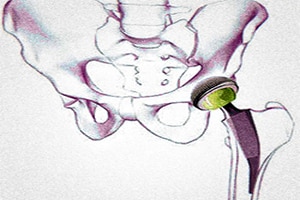 Hip Prosthesis Stem