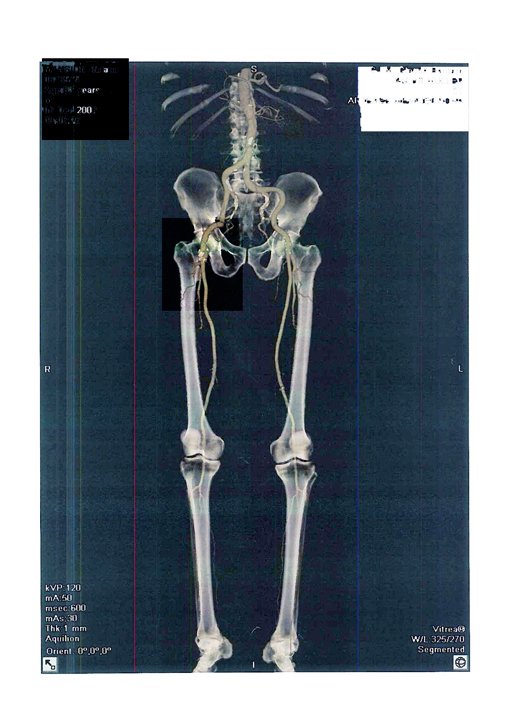 Femoral Trial