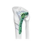 Link® Tibial Plateau