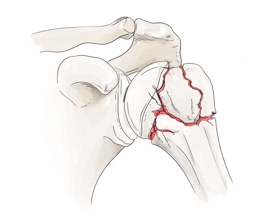 Endo-Model® Proximal Humerus Replacement