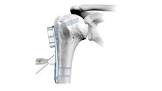 Endo-Model® Proximal Humerus Replacement