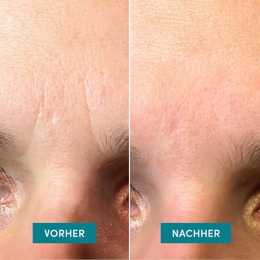 APRICOT Gesichtspatches Ect face charmer 100 Stk