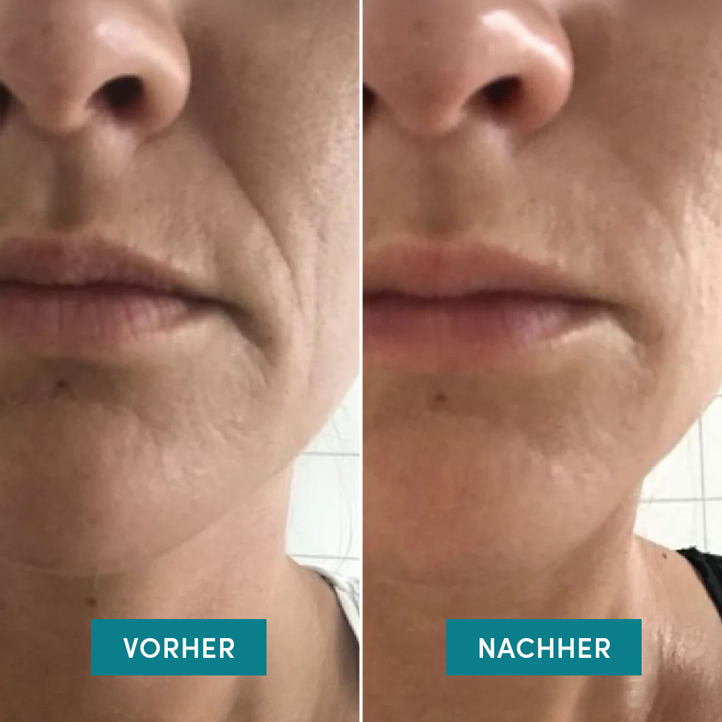 APRICOT Mund Patches Niacinamid skin whisperer