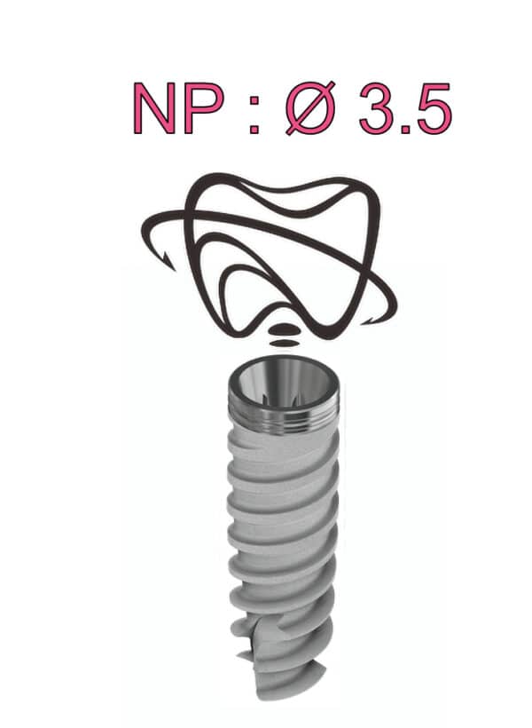 IMPLANT G6626745 NP LORDO 5MMX17MMX14MM