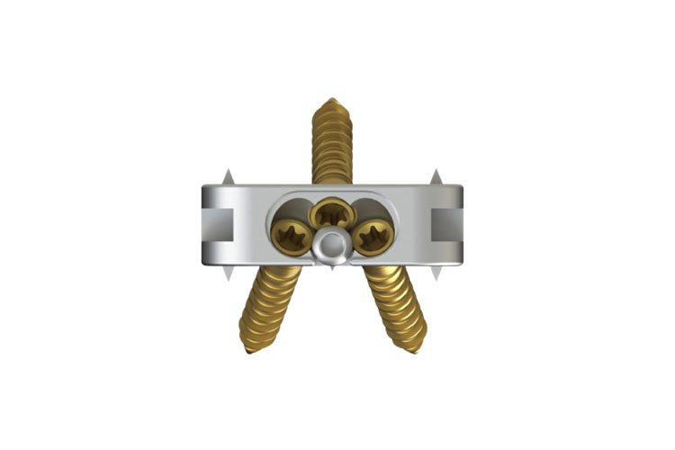 CAGE 369121610 MEDIUM TI ALIF 16DEGX10MM
