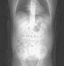 CRTD DTMB2D4 AMPLIA MRI OUS DF4