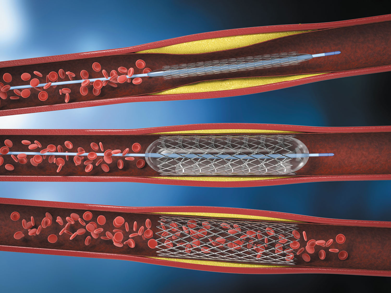 STENT GRAFT ETEW1010C82EE ENDUR II ILEXT
