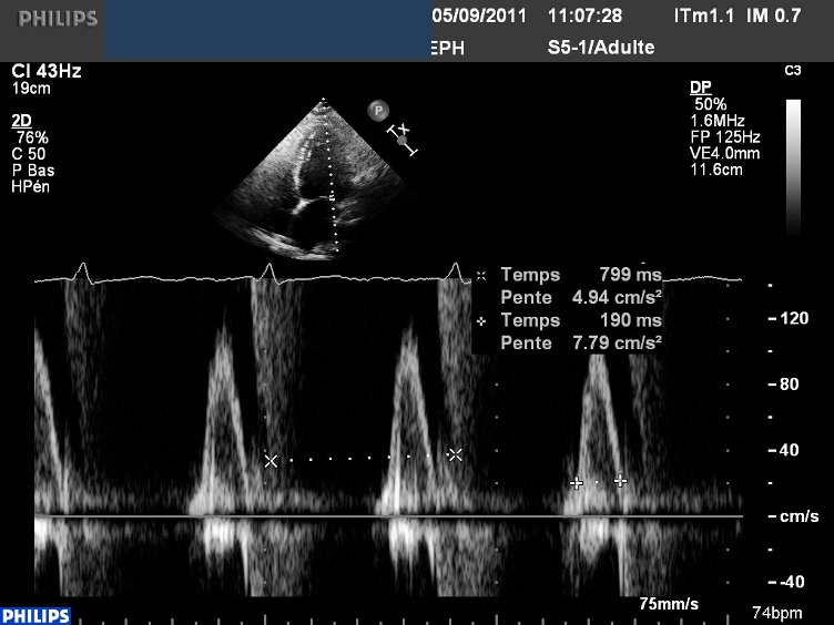 MHV 500DM33 STD MITRAL