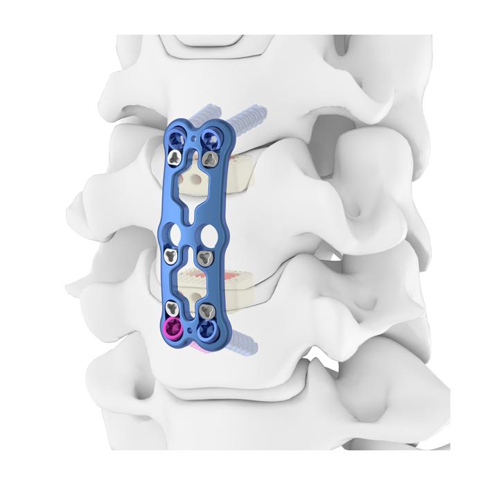 PLATE 876-130 30MM ANTERIOR CERVICAL