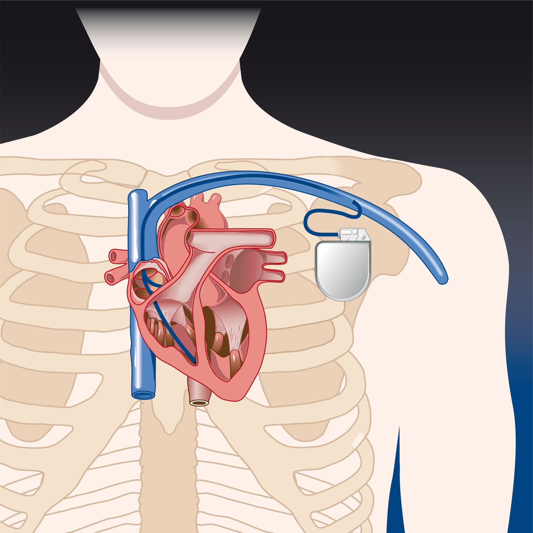 TEMP PACEMAKER MEP3000 EN VIT