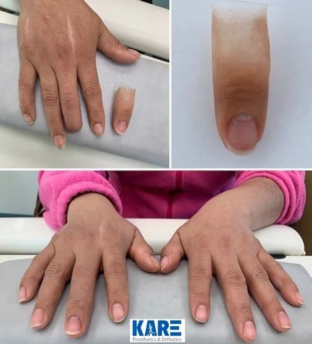PROSTHESIS 1112095 H/A PARTIAL 90DEG OFF