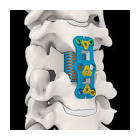 PLATE 976-175 75MM ANTERIOR CERVICAL