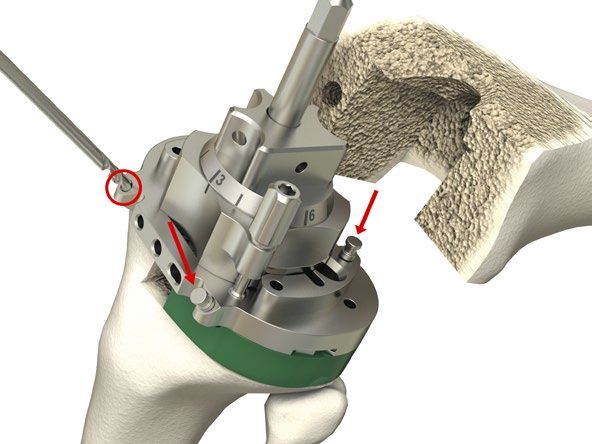 PROSTHESIS 1156621 PLAT/TI .5X4.5MM RT