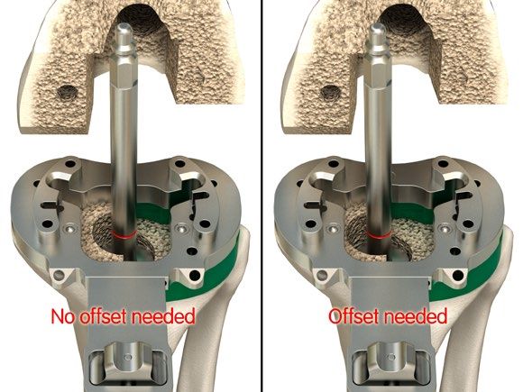 PROSTHESIS 1156622 PLAT/TI .5X4.75M RT