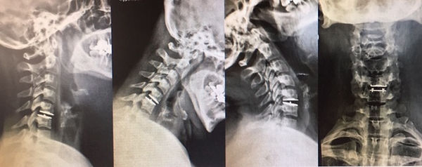 MOTION 6971260 CERVICAL DISC 6MM X 12MM