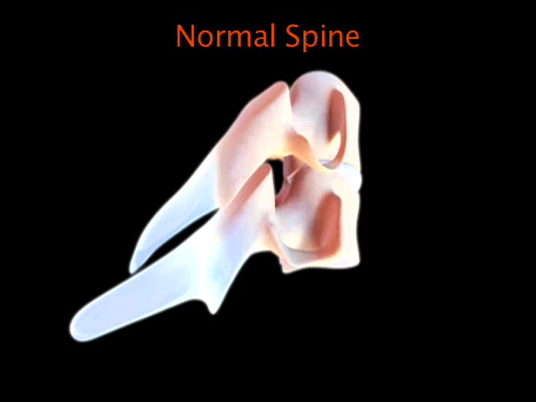 MOTION 6971460 CERVICAL DISC 6MMX14MM