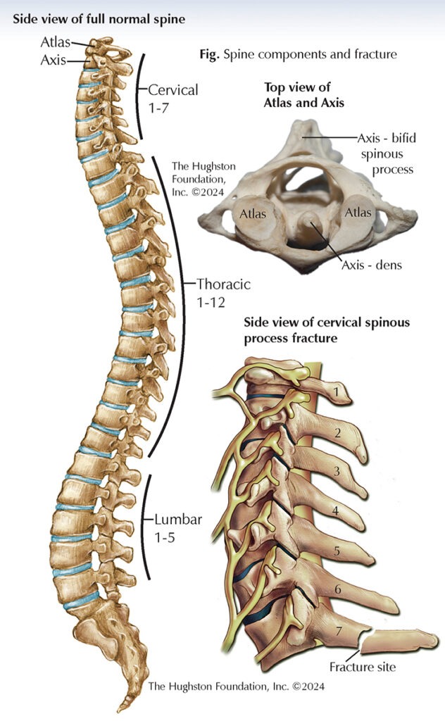 PLATE 9240100 SPINOUS PROCESS
