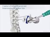 DEMO SYNFLATE VERTEBRAL