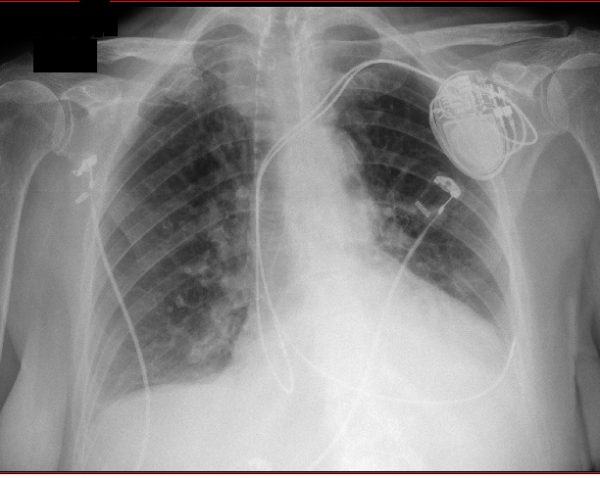 INLET 44010 VENTRICULAR PORT SIDE