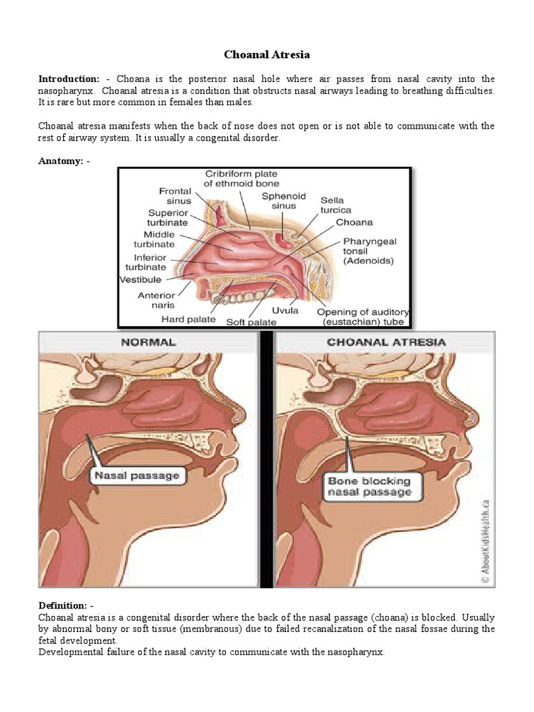 BUR 1883673HS 3PK CHOANAL ATRESIA TAPER