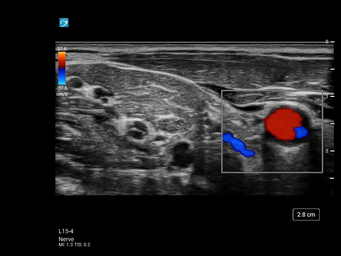 BLOCK 9732134 SONOSITE VERIFICATION