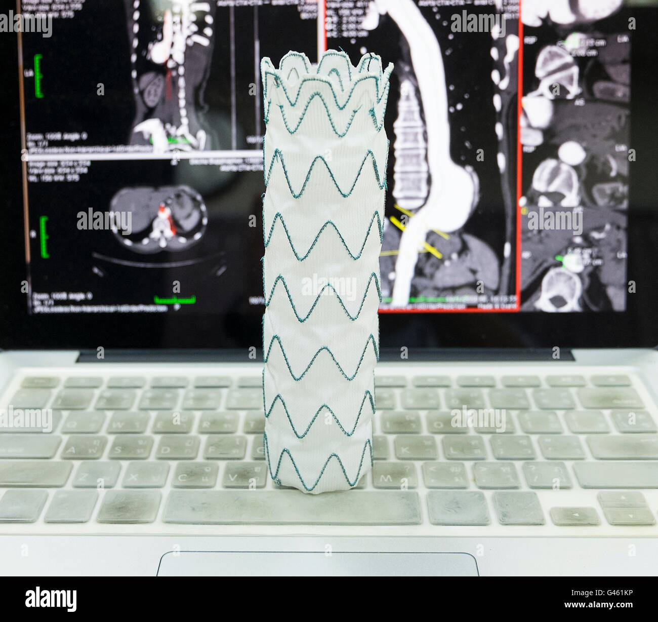 STENT GRAFT ETTF2525C70EE ENDUR II TUBE