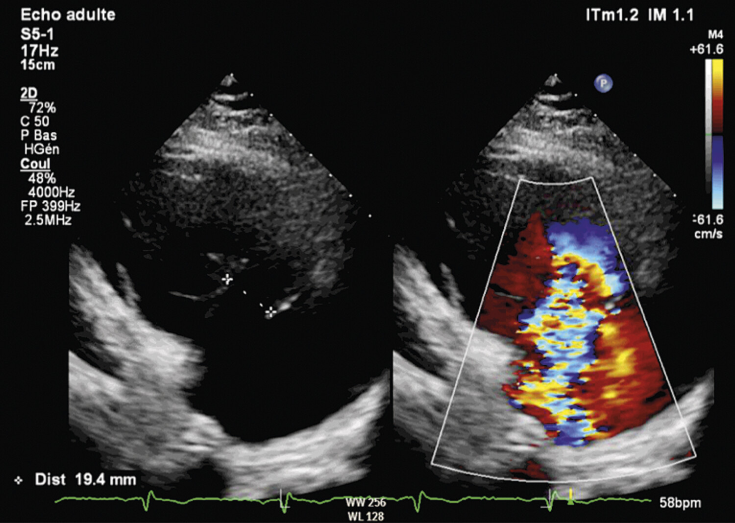 BAND 900SFC234 TRI-AD2.0 ADAMS TRICUSPID