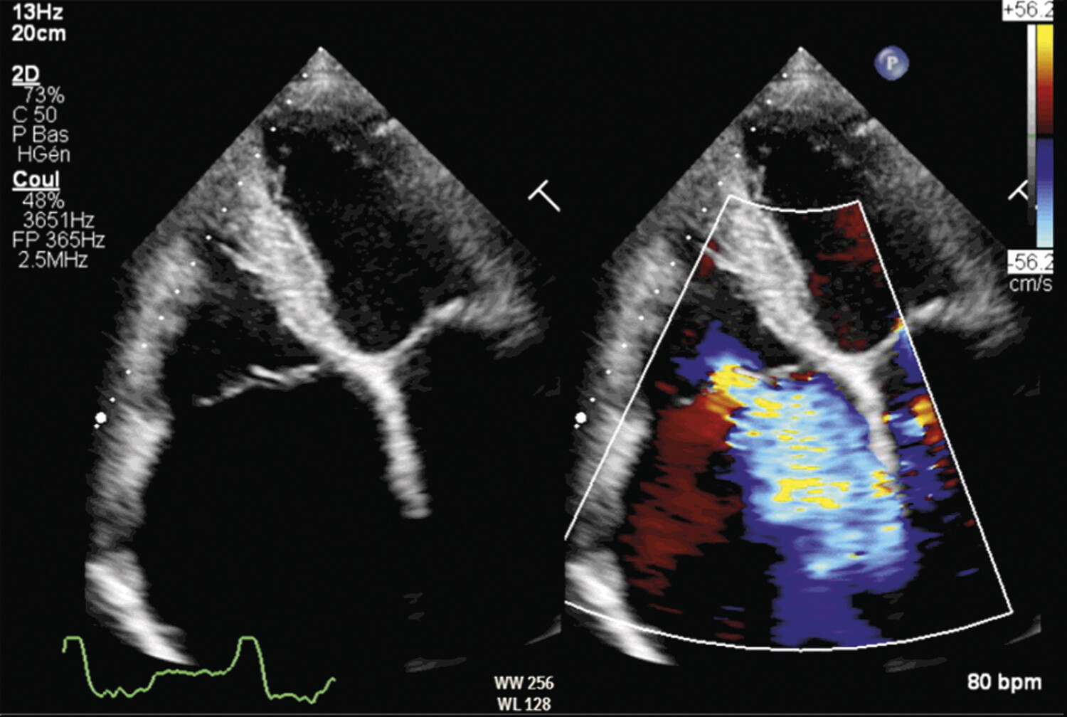 BAND 900SFC234 TRI-AD2.0 ADAMS TRICUSPID