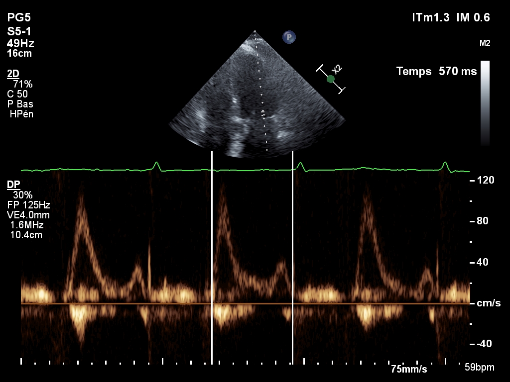 BAND 900SFC236 TRI-AD2.0 ADAMS TRICUSPID