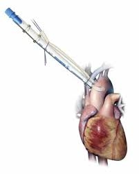 CANNULA CB91246 MC2 VEN 34/46FR