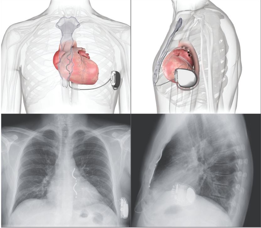 ICD-VR DVEX3E4 EV ICD EV4 PIVOTAL