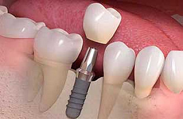 IMPLANT DEVICE ISF-060-030 ARTISSE
