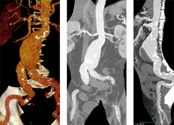 STENT GRAFT ETLW1624C124EE ENDUR II LIMB