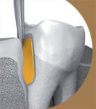 PerioChip, Insert zur peridontalen Anwendung