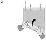 Multibic 4 mmol/l Kalium, Hämofiltrationslösung