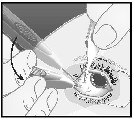 Ozurdex, intravitreales Implantat in Applikator