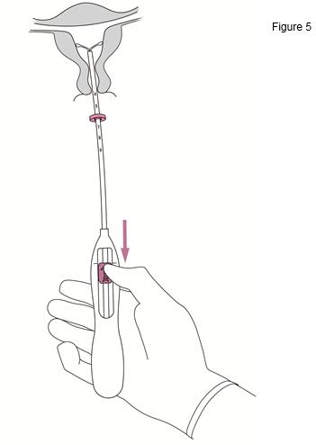 Jaydess 10 mcg/24 Stunden, Intrauterines Wirkstofffreisetzungssystem