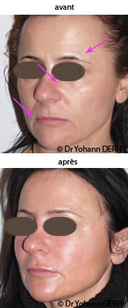 ACIDE ZOLEDRONIQUE Onco Sandoz 4 mg/100ml flac