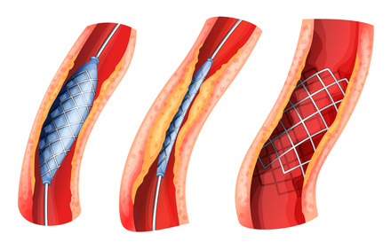 STENT SEPX-8-6-40-135 PROTEGE RX