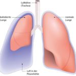 Pneumothorax Set, 1 Set