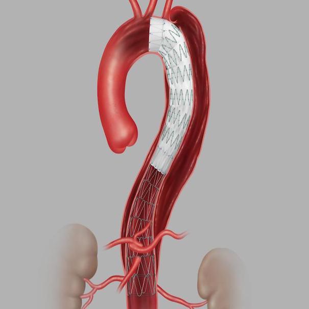 Zenith Tx2 Dissection Endovascular Graft Straight Component, 1 Each