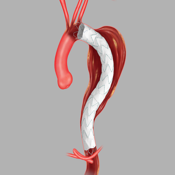 Zenith Tx2 Taa Endovascular Graft Taa Ancillary Component Proximal Extension, 1 Each