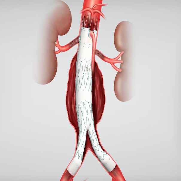 Zenith Fenestrated Aaa Endovascular Graft Proximal Body, 1 Each